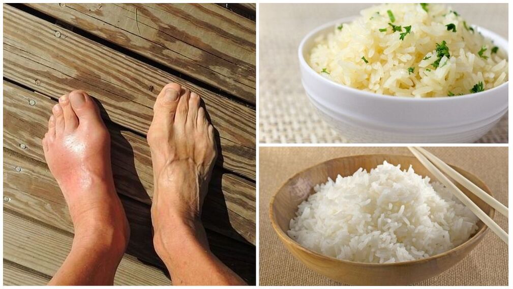 A rice-based diet is recommended for gout sufferers. 